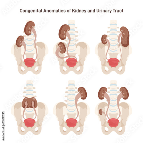 Congenital anomaly of kidneys set. Urinary system organ inborn