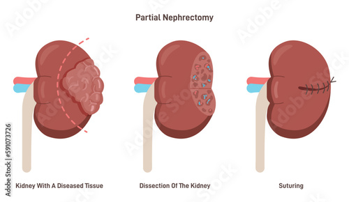 Partial nephrectomy surgery. Diseased swelling tissue surgical removal.