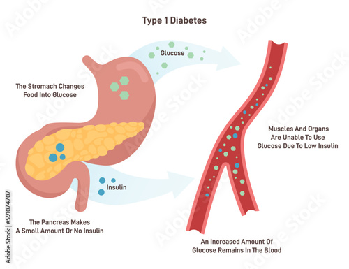 Type 1 diabetes. Juvenile diabetes or insulin-dependent diabetes. photo