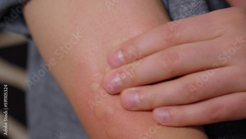 Vaccination reaction on arm of man after injection from allergy. Swollen part. Selective focus