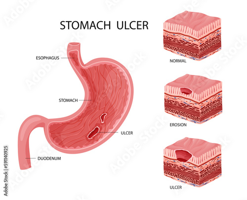 Stomach erosion and ulcer illustration