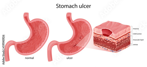 Normal stomach and peptic ulcer illustration