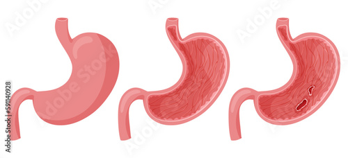 Peptic ulcer in human stomach