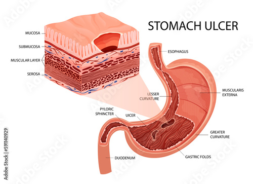 Peptic ulcer in stomach infographic