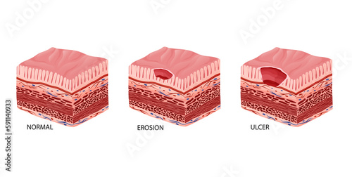 Peptic ulcer stages development illustration