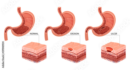 Stomach erosion and ulcer illustration
