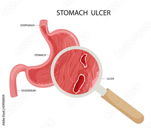 Peptic ulcer in stomach under magnyfication