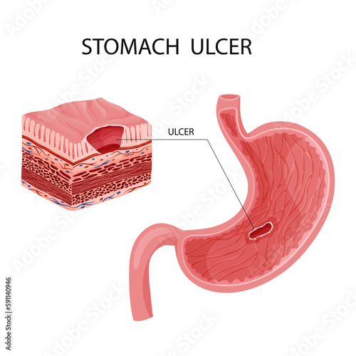 Peptic ulcer in stomach illustration