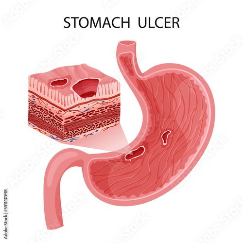 Peptic ulcer in stomach with layers visualization