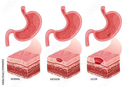 Stomach erosion and ulcer development illustration