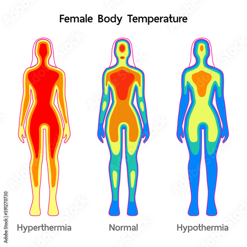 Female body Temperature model Normal, Hyperthermia and hypothermia health care infographic. Vector flat healthcare illustration. Body cooling infrared heat map isolated on white background.