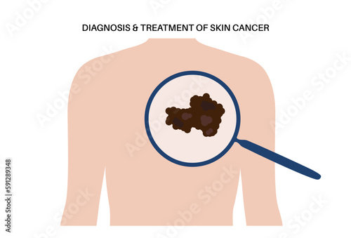 Skin cancer diagnosis