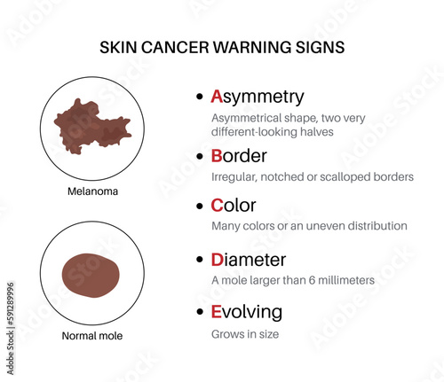 Melanoma warning signs