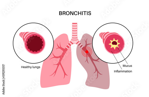 Bronchitis lung disease