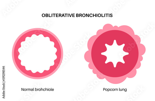 Bronchiolitis lung disease