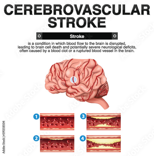 Informative poster of Cerebrovascular stroke