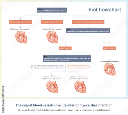 When acute inferior myocardial infarction occurs, the ST segment offset of the electrocardiogram can be used to derive the culprit vessel, commonly known as the Fiol process. photo