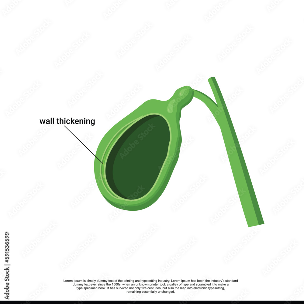 Illustration of the gallbladder wall thickening. Vector immage of the