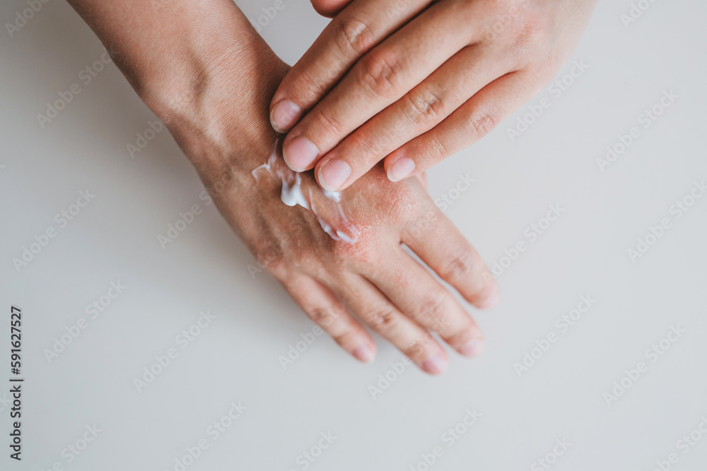 A person smears a skin rash on her hands with a therapeutic cream. Skin itching, eczema, skin allergies.