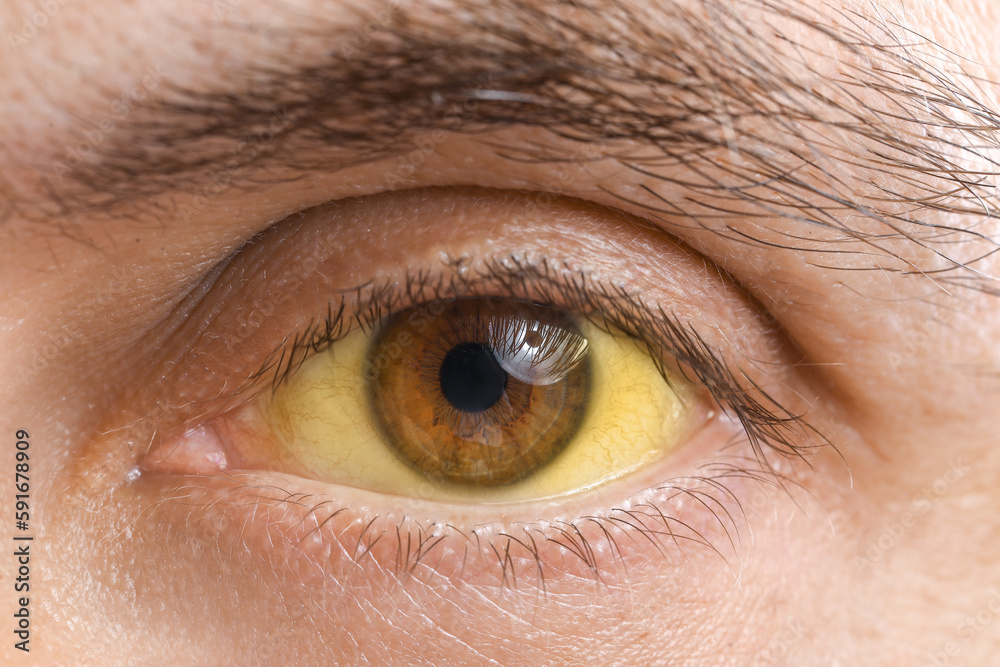 Fototapeta premium Man with yellow eyes, closeup. Hepatitis symptom