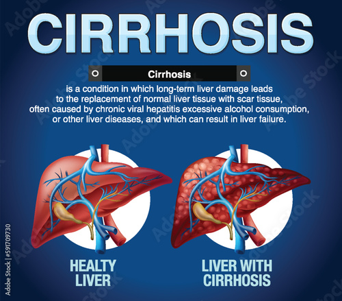 Cirrhosis of the Liver Infographic