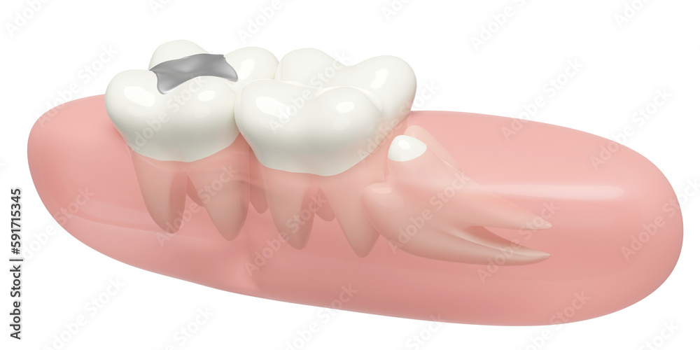 dental examination of the dentist, 3d wisdom teeth model problems icon with gums isolated. health of white teeth, oral care, 3d render illustration dental examination of the dentist, 3d wisdom teeth model problems icon with gums isolated. health of white teeth, oral care, 3d render illustration