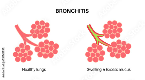 Bronchitis lung disease