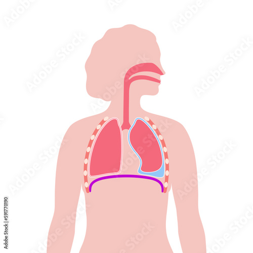 Pleural effusion poster