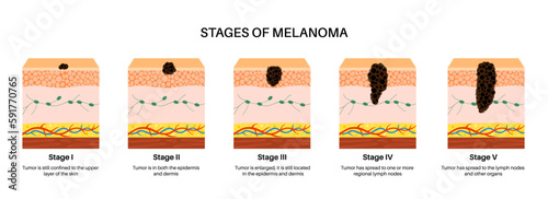 Melanoma stages poster