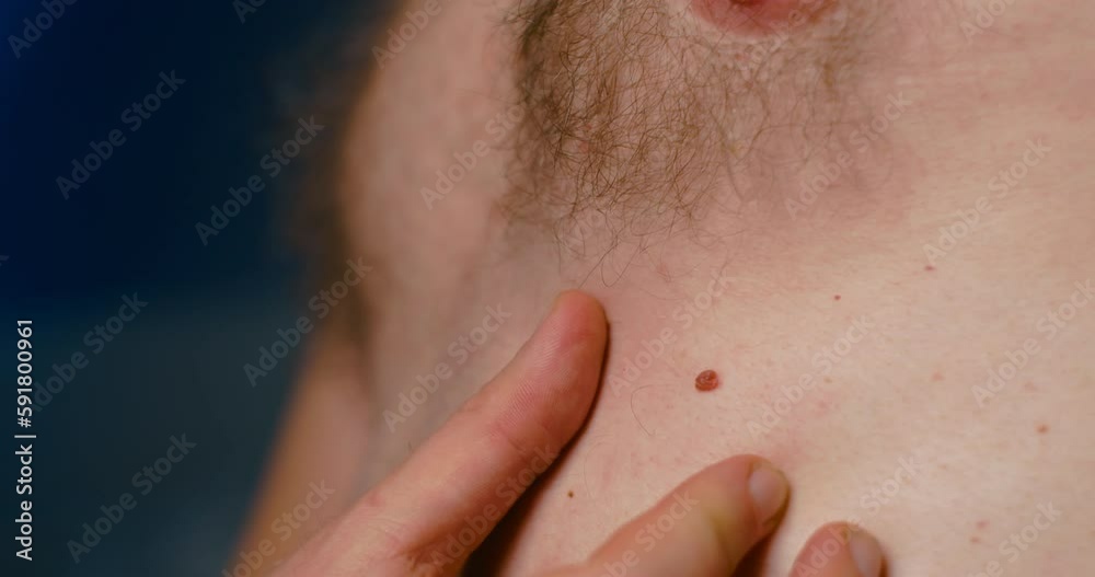 Close up of man investigate mole on body, problem skin Close up of man investigate mole on body, problem skin