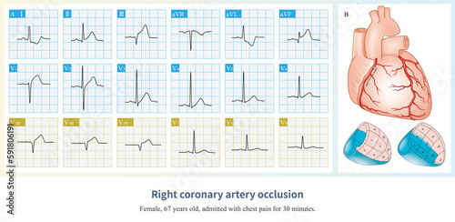 Acute occlusion of the proximal to middle segment of the right coronary artery can clinically cause myocardial infarction in the right ventricle, inferior and posterior wall.