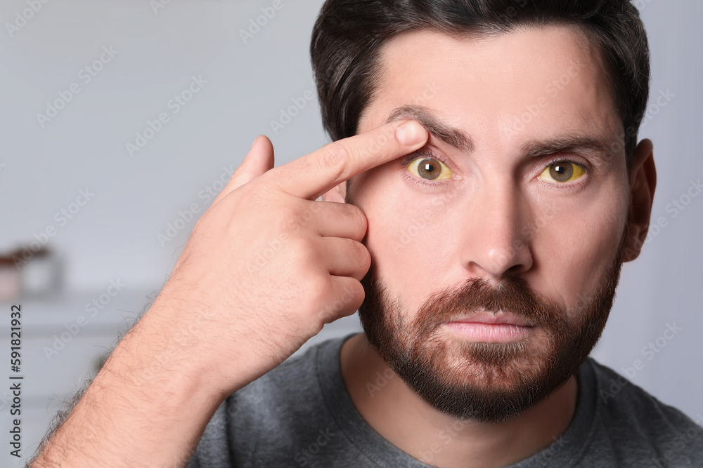 Man with yellow eyes on blurred background. Symptom of hepatitis Man with yellow eyes on blurred background. Symptom of hepatitis