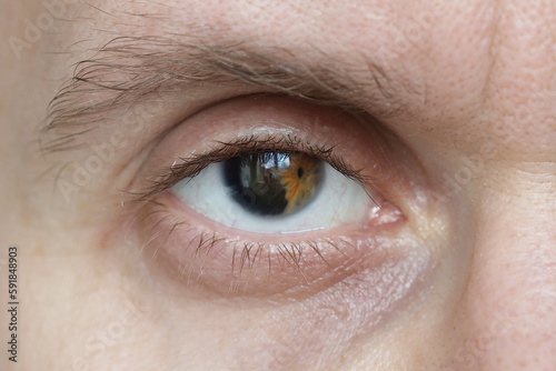 A person with degeneration of the iris in the eye. vision diseases