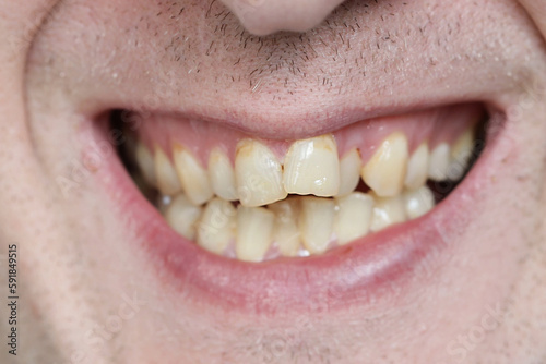 A person with malocclusion. crooked teeth