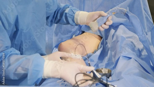 Surgical operation on leg veins, endovenous ablation, sclerotherapy and vein removal photo