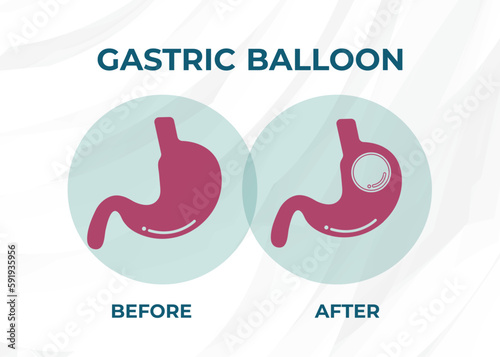 Stomach Endoscopy Gastric Balloon Inside a Stomach weight loss surgery vector illustration obesity 
