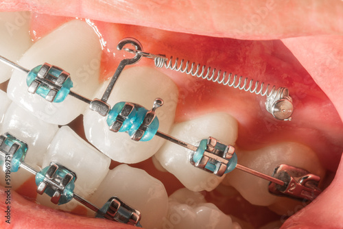 Align braces, bracket care, check, chrome, cleaning, clinic, close-up, coil, dental, dentist, dentistry, dentists, equipment, examination, flexibility, flexible, gum, health, healthy, hygiene, jaw, la