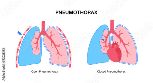 Pneumothorax anatomical poster