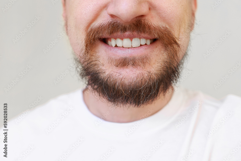 Cropped photo of bearded man first gray hairs on overgrown shaggy beard and moustahe. Loss of melanin at young age, causes-genetic predisposition, hormonal, disorders of the endocrine system
