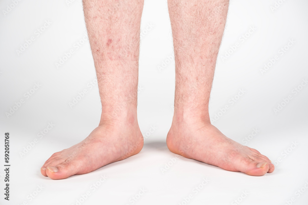 Close up of mans bare foot with strong flat feet also called pes planus or fallen arches. Close up of mans bare foot with strong flat feet also called pes planus or fallen arches.