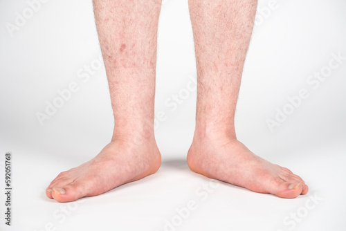 Close up of mans bare foot with strong flat feet also called pes planus or fallen arches.
