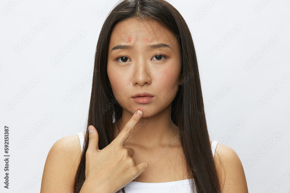 Asian woman facial skin problems, acne and inflammation, red rashes and allergies, chicken pox, sadness from rashes. Facial skin care concept for diseases and nerves Asian woman facial skin problems, acne and inflammation, red rashes and allergies, chicken pox, sadness from rashes. Facial skin care concept for diseases and nerves