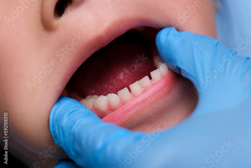 Close-up inside the oral cavity of a healthy child with beautiful rows of baby teeth. Young girl opens mouth revealing upper and lower teeth, hard palate, soft palate, dental and oral health checkup.