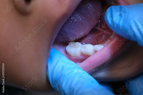 Close-up inside the oral cavity of a healthy child with beautiful rows of baby teeth. Young girl opens mouth revealing upper and lower teeth, hard palate, soft palate, dental and oral health checkup.