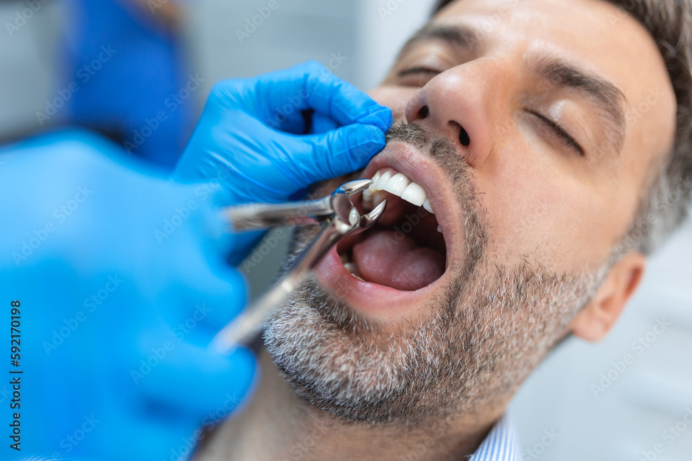 Surgeon removing the tooth. Dentist using surgical pliers to remove a tooth in clinic Surgeon removing the tooth. Dentist using surgical pliers to remove a tooth in clinic