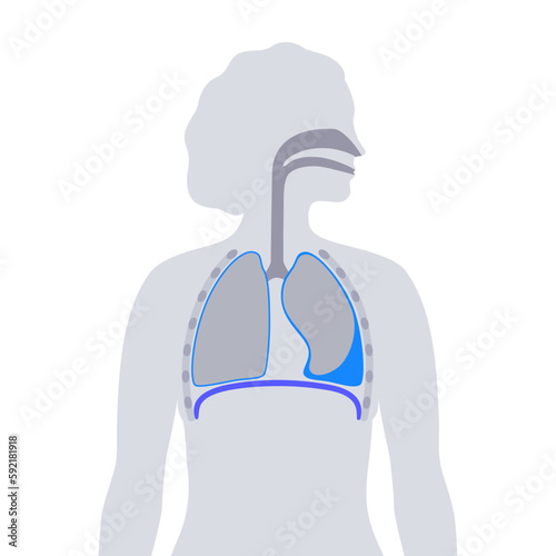 Pleural effusion poster