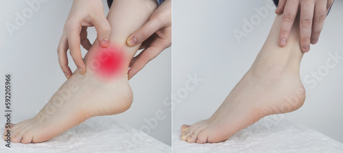 Achilles tendon. Woman show intervertebral hernia, foot dislocation, cartilage damage. Concept material. On one half there is a problem, and on the second - the problem is cured. photo