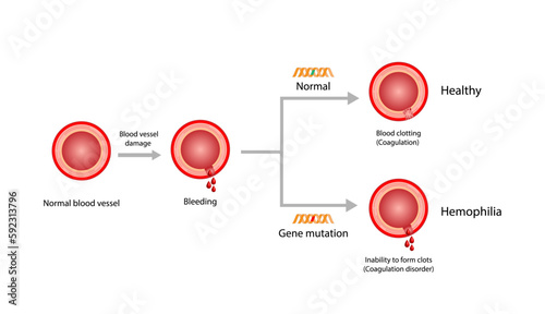 Hemophilia, a bleeding disorder that slows the blood clotting. Haemophilia (Coagulation disorder). Damaged blood vessel, hemorrhage. Healthy blood vessel after bleeding. Vector illustration.