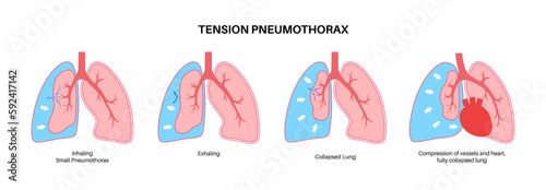 Tension pneumothorax poster photo
