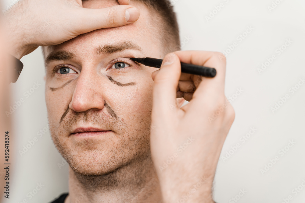 Obraz premium Close-up male blepharoplasty for man markup on the face before plastic surgery operation for modifying the eye region in medical clinic.